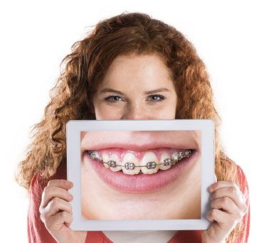 Instructions for Orthodontic Patients in kuwait