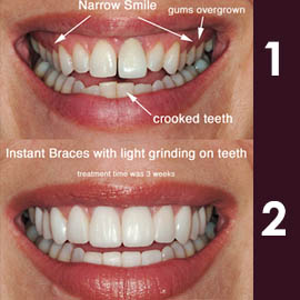 Clear Aligners
