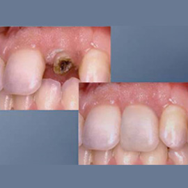 Crown Lengthening and Post Core Crowns kuwait
