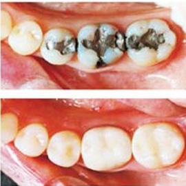 Dental Cosmetic Fillings Kuwiat