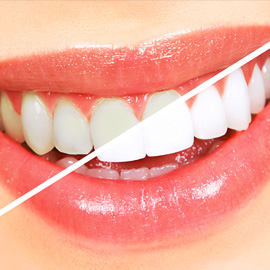 Whitening of Teeth Kuwait