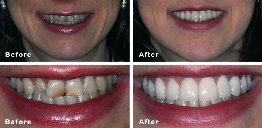 dental implants treatments in Kuwait
