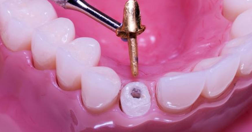 crown lengthening treatments in Kuwait