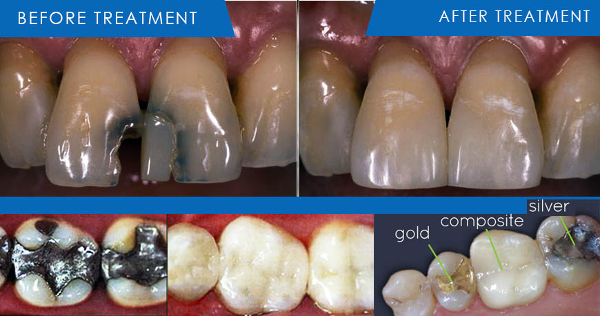 dental cosmetic filling kuwait