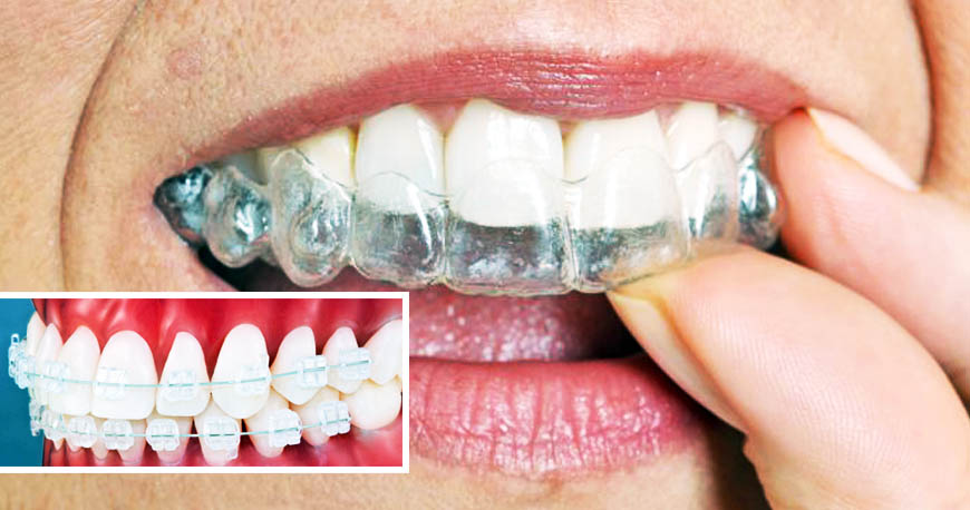 Orthodontics in Kuwait