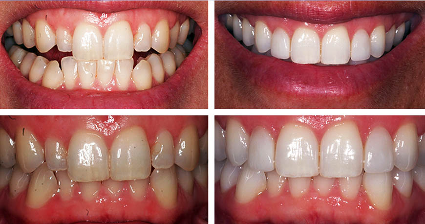dental implants treatments in Kuwait